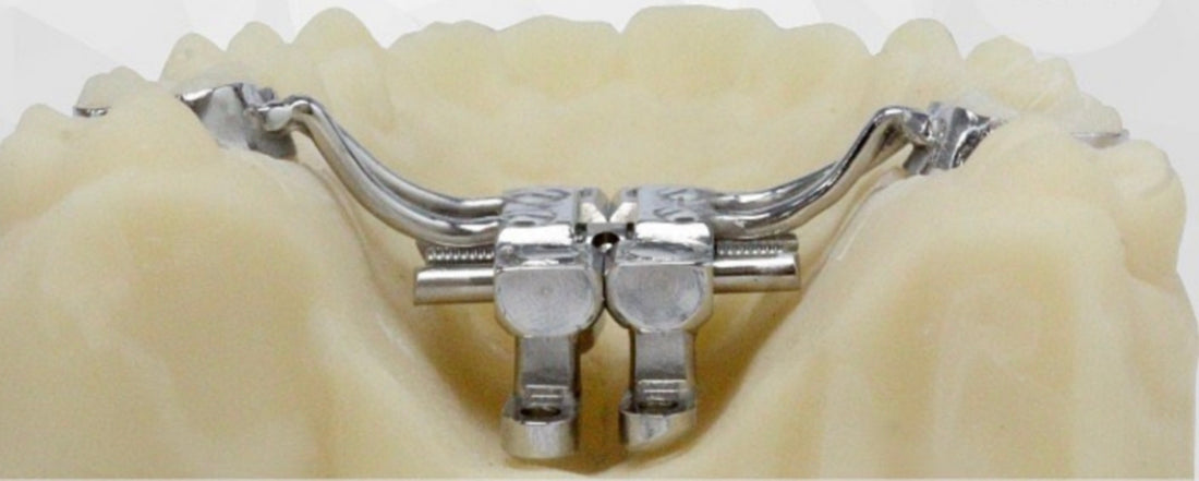 MARPE (MINI-IMPLANT ASSISTED RAPID PALATAL EXPANSION