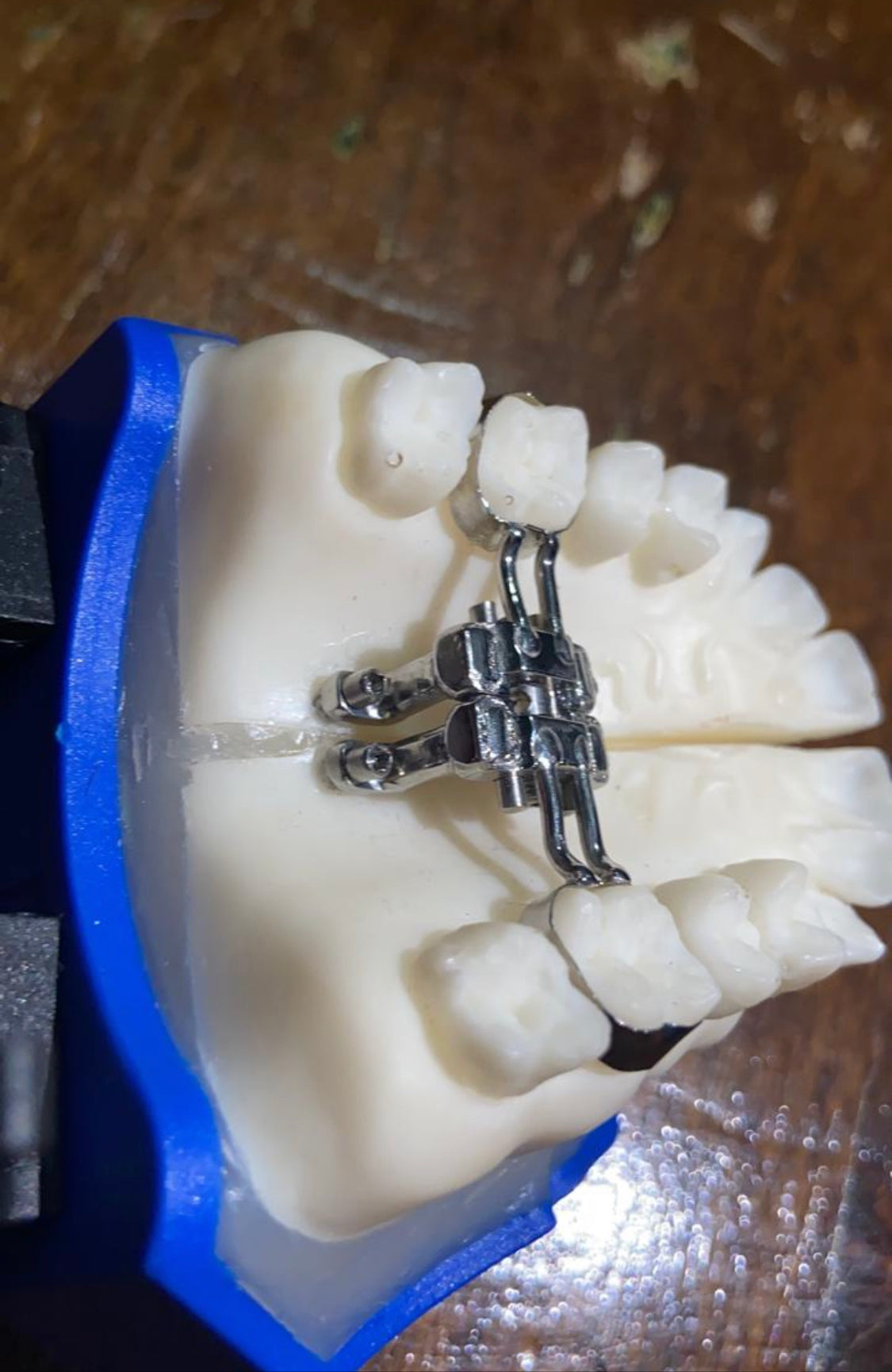 MARPE (MINI-IMPLANT ASSISTED RAPID PALATAL EXPANSION