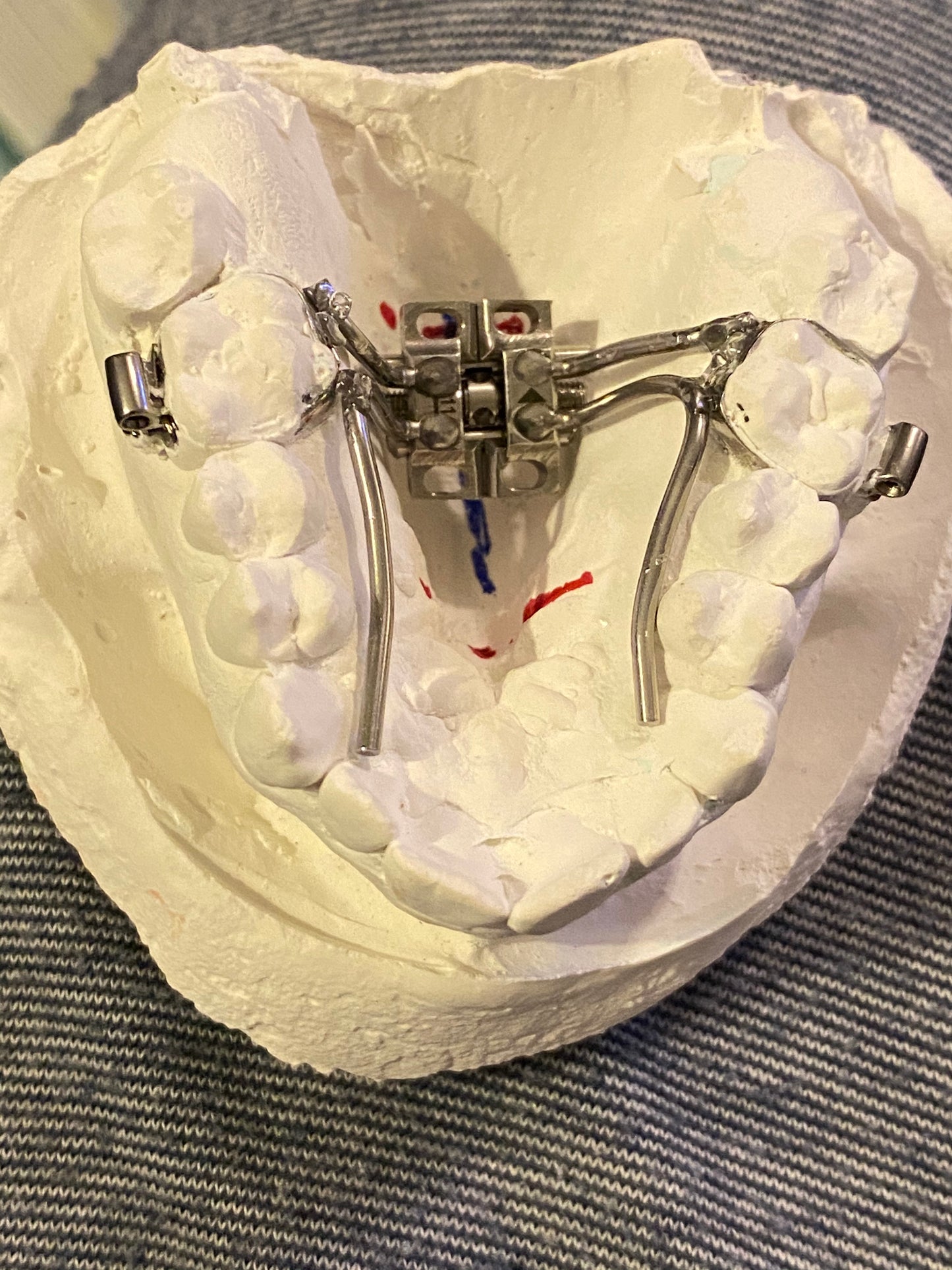 MARPE (MINI-IMPLANT ASSISTED RAPID PALATAL EXPANSION