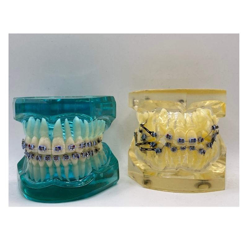 ORTHODONTIC MODEL +SCREW/ORTHODONTIC MODEL+CLEAR