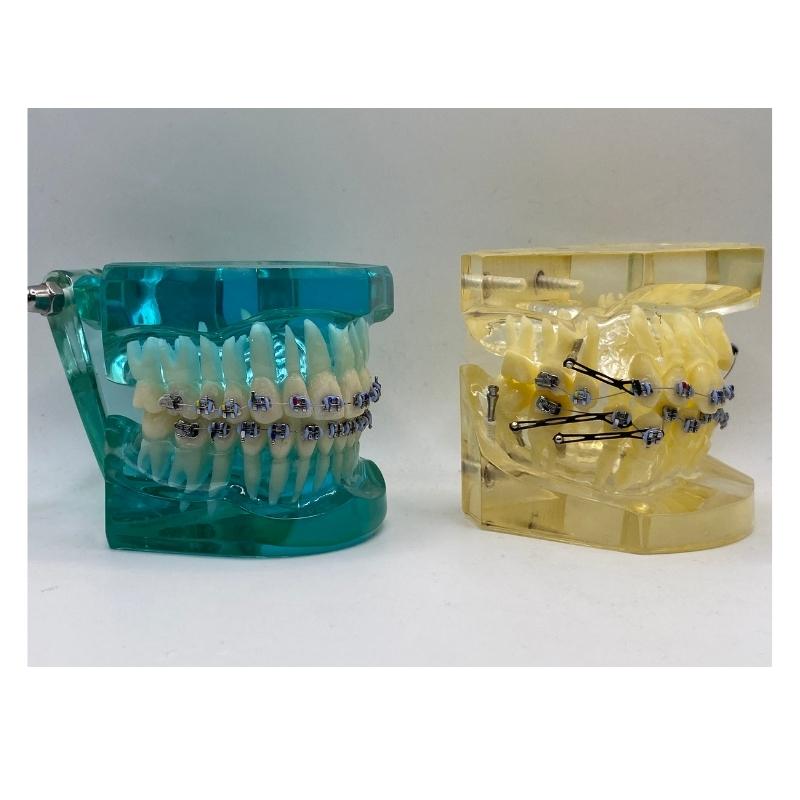 ORTHODONTIC MODEL +SCREW/ORTHODONTIC MODEL+CLEAR